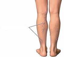 Simptome ale varicelor la femei: 7 semne că picioarele tale sunt în pericol - Profilaxie - August