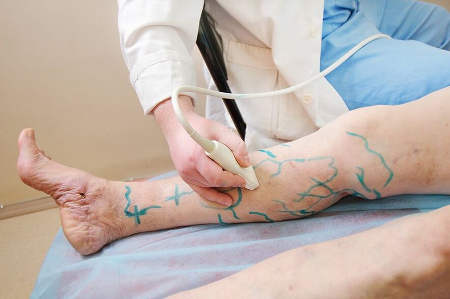Pregătirea pentru miniflebectomie - marcare pe perforatoarele inferioare ale piciorului, efectuarea ultrasonografiei